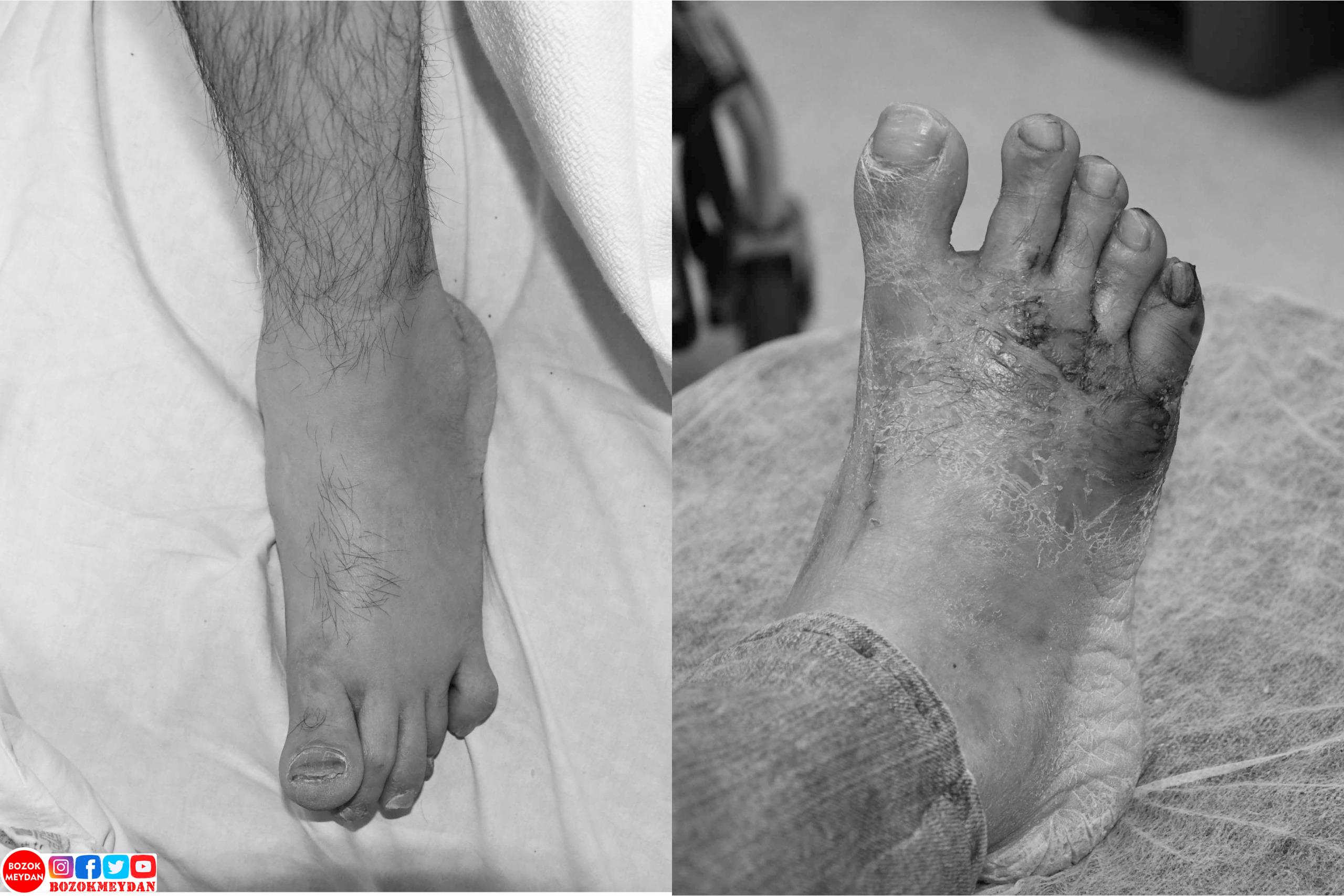 Yozgat Şehir Hastanesinde Serebral Palsili Hastaya Ameliyatla Yürüme İmkanı